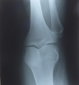knee_x-ray,knee,x-ray,ray,bike,accident,crash,bone,leg,
